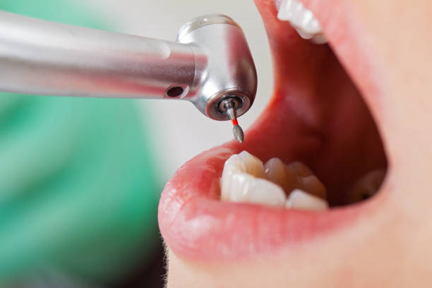 Best Lost Filling or Crown Replacement in Cambridge, MA